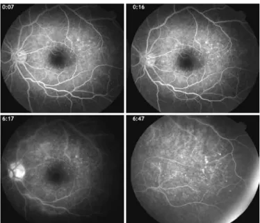 Figure 3. The same patient from igure 2, showing hyperluorescent dots in a wreath-like  swirl coniguration at the posterior pole and temporal periphery