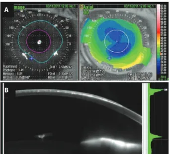 Figure 2. A) Preoperative topography demonstrating irregular astigmatism, B)  Scheimplug image indicating prior LASIK lap preparation.