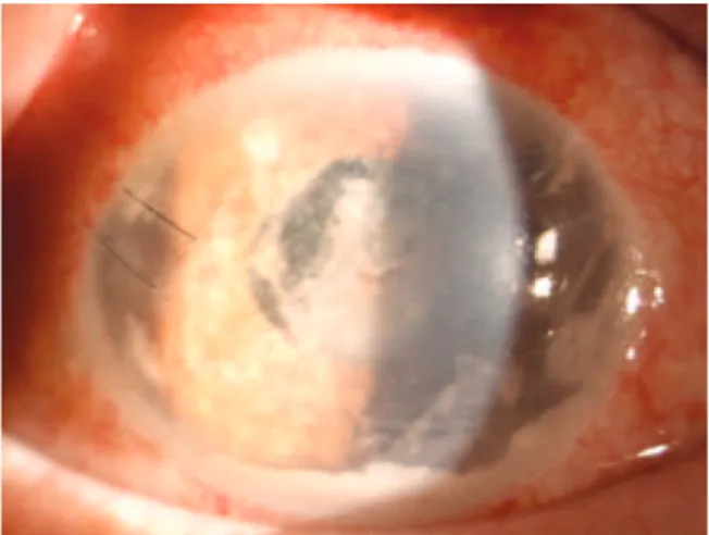 Figure 1. Slit-lamp photograph showing a white locculent mass with a mo- mo-derate ibrin response and cellular reaction in the anterior chamber.