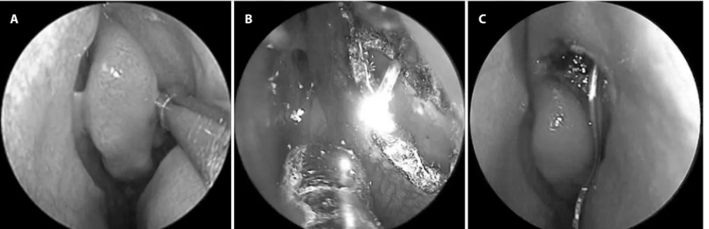 Figure 1. A) Red relex of the laser probe at lacrimal fossa. B) Ostium created by the diode laser