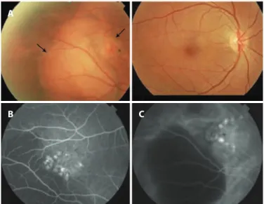 Figure 3. Peripheral retinography of OD a year after diagnosis of the lesion. Note  that the lesions changed, showing discoloration and a decrease in dimension.