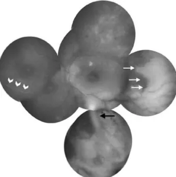 Figure 1. Fundus photography of the left eye at presentation showing mild optic disc  edema, macular striations, occlusive vasculitis (white arrow heads), scattered retinal  hemorrhages, clear cut whitening of peripheral retina (white arrows), and the IV-D