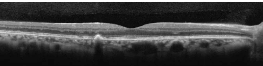 Figure 3. Spectral domain optical coherence tomography [SD­OCT] showing elevated lesions located along the retinal pigment  epithelium (RPE)/Bruch complex and preserving the external limiting membrane.