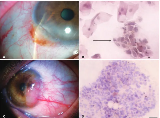 Figure 1. Examples of IC in the evaluation of lesions of melanocytic origin: A) Anterior segment slit-lamp photograph demonstrating a conjuncti- conjuncti-val nevus