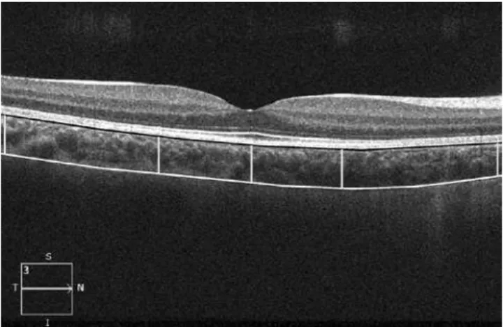 Figure 1. A representative Cirrus HD-OCT image. The lines show choroidal thickness  measurements retrieved perpendicularly from the outer edge of the hyper-relective  retinal pigment epithelium (black line) to the border with the sclera (white line)
