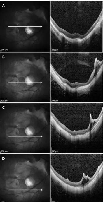 Figure 4. A) OCT after the second vitrectomy with ILM peeling shows resolution  of MF