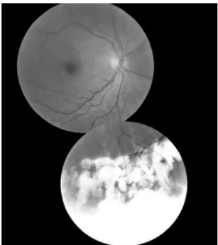 Figure 4. Postoperative melanoma resected en bloc; the whitish area  corresponds to the scleral lap delimited by photocoagulation marks  in the eye with VA of 20/20