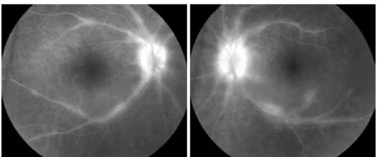 Figure 3. Indocyanine green angiogram detecting hypolucent round lesions correspon- correspon-ding to areas of choroidal vascular nonperfusion.