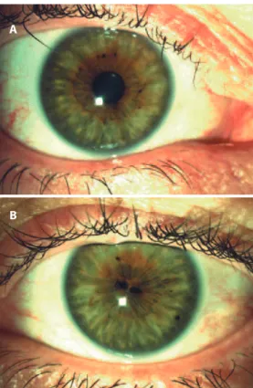 Figure 2. A) Preoperative image of the right (normal) eye after  pupil dilatation; B) Preoperative image of the left eye after pupil  dilatation, showing true polycoria.