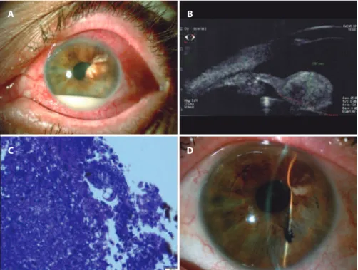 Figure 2. Case 2. A) Photograph of a white pearl mass in the temporal upper quadrant associated with bulging of the  iris superiorly