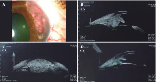 Figure 3. Case 3. A) Biomicroscopy image demonstrating a pink iris mass from 1 to 3 o’clock with intrinsic vessels