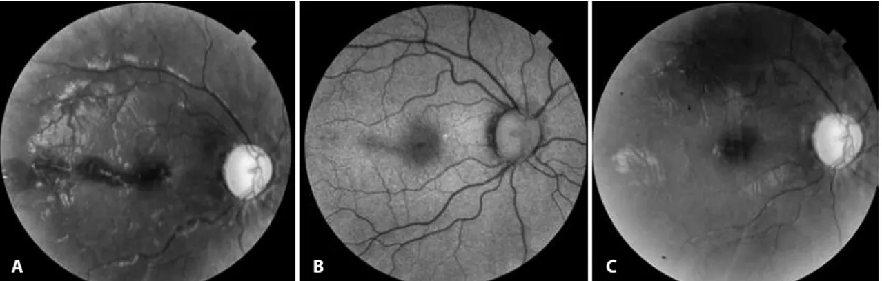 Figure 1. A) Grey-scale fundus image of the right eye showing foveal and extrafoveal retinal hemorrhage 5 days after the roller coaster ride