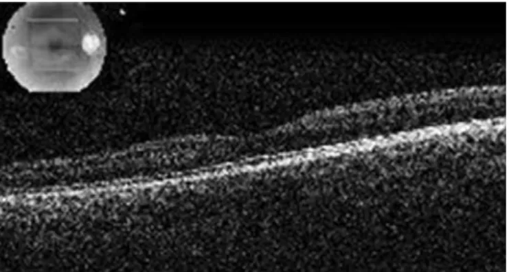 Figure 3. Normal spectral-domain optical coherence tomography image of the fovea  six months after presentation as seen with the minimal hyper-relectivity of internal  limiting membrane (ILM) at the fovea.
