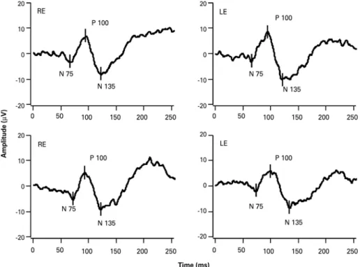 Figure 3. Transient pattern-reversal visually evoked potentials of the right and left eyes in a 32-year-old male (patient #6)  with informed visual acuity of 20/250 in the right eye, the ability to count ingers with the left eye, and inancial motivation.