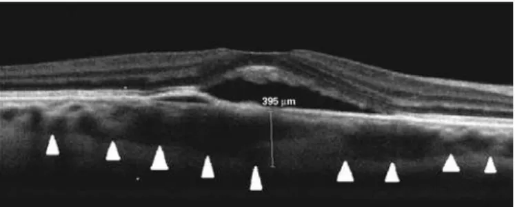 Figure 1. Baseline enhanced depth imaging spectral-domain optical coherence tomo- tomo-graphy imaging of a patient with acute central serous chorioretinopathy