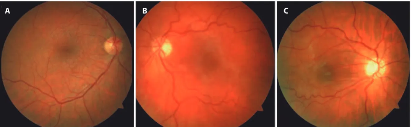 Figure 1. Fundus grading of the epiretinal membrane (ERM). A) Example of a grade 1 ERM with minimal retinal surface changes
