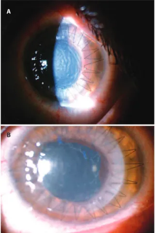 Figure 1. A) Severe postoperative corneal edema; B) 5 days postoperatively,  the corneal edema and pupillary membrane formation decreased.