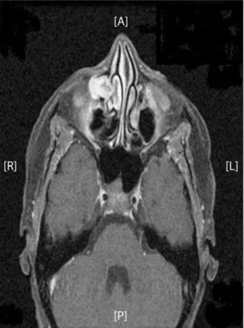 Figure 1. Solid-cystic lesion occupying the right lacrimal sac region consistent  with a neoplastic process.
