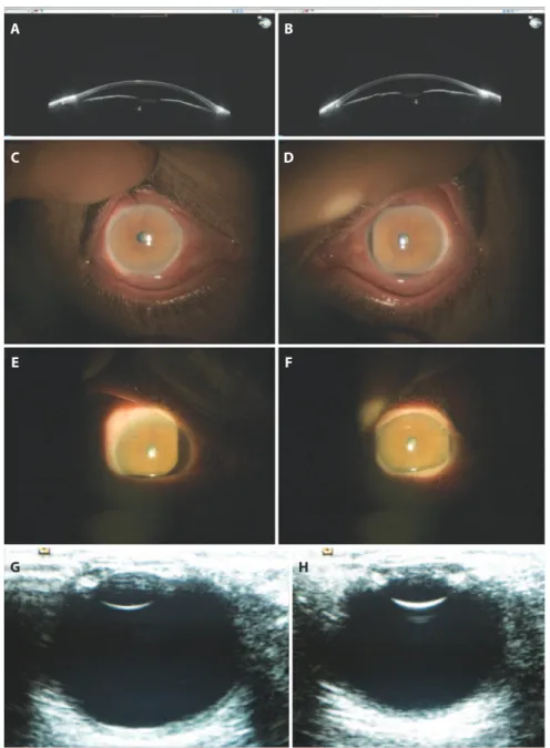 Figure 1. A, B) Sirius topography revealed narrow angles in both eyes on the second day