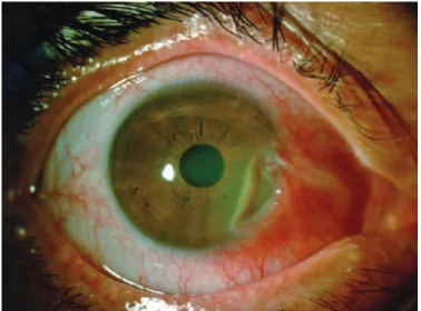 Figure 2. Left eye before rituximab. Conjunctival hyperemia, scleral thinning, and asso­
