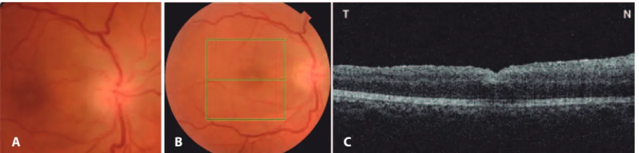 Figure 2. A) Fundus retinography demonstrating optic disc edema afecting the right eye 7 days after surgery