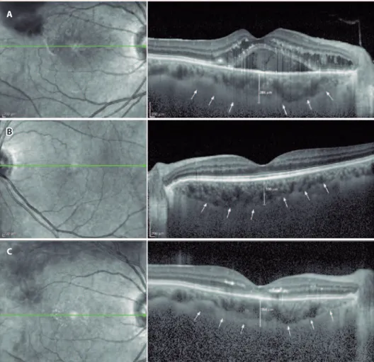 Figure 1. A typical choroidal image and the measurement points. A) Branch retinal vein occlusion (BRVO) eye