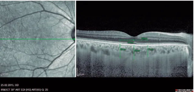 Figure 1. Example of enhanced depth imaging-optic coherence tomography measurements. Central subfoveal choroidal thickness (CSCT), temporal  choroidal thickness (TCT; 1 mm temporal CT from the fovea), and nasal choroidal thickness (NCT; 1 mm nasal CT from 