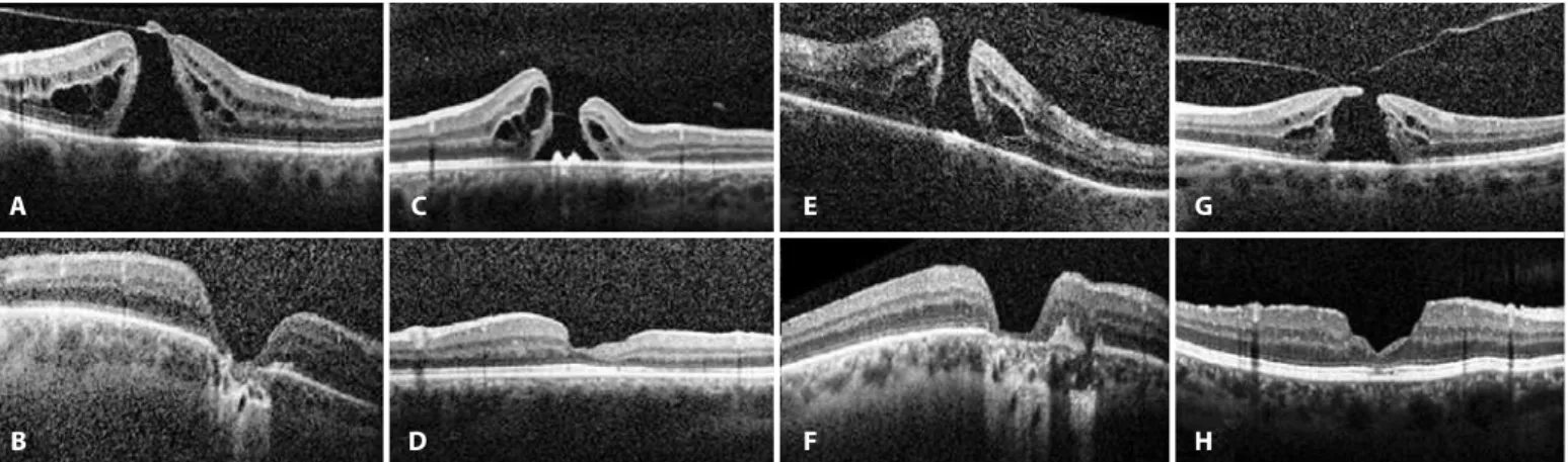 Figure 4. Preoperative (A, C, E, and G) and postoperative (B, D, F, and H) SD-OCT of patients with macular atrophy after 4-port 23-gauge PPV combined with ILM peeling and intrao- intrao-cular 20% SF6 tamponade.