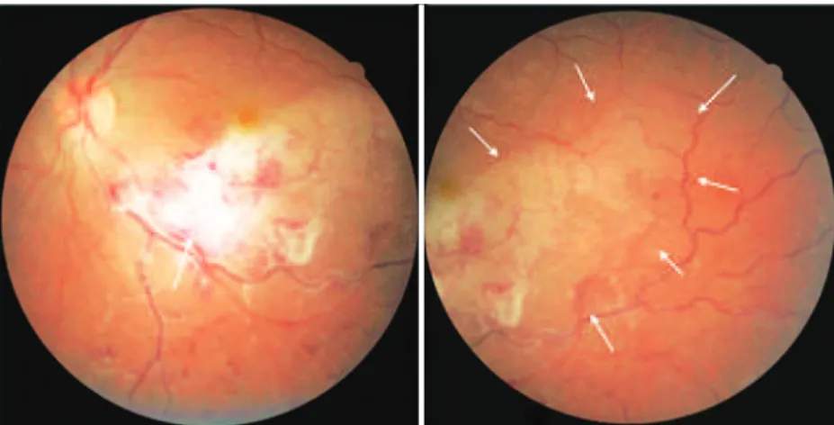 Figure 1. Initial presentation: Fundus photography of the left eye showing a white, poorly demarcated, and  slightly elevated retinal lesion at the proximal portion of the inferotemporal vascular arcade (arrow, left)