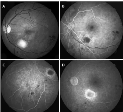 Figure 4. Vertical cross-sectional optical coherence tomography image of the left eye  showing signs of partial posterior hyaloid detachment, inferior macular inner and middle  retinal atrophy, hyperrelective intraretinal dots superior to the fovea, as wel