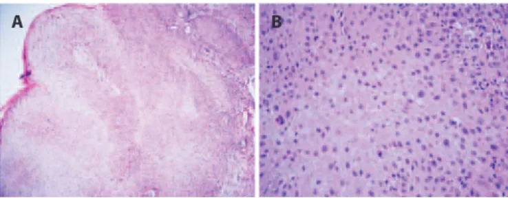 Figure 1. White, nodular mass on the nasal conjunctiva adjacent to the  limbus. The mass was 4 × 5 mm in size and surrounded by dilated vessels.
