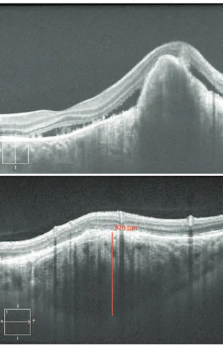 Figure 1. Color photograph of a choroidal osteoma with associated cho ­ roidal neovascularization