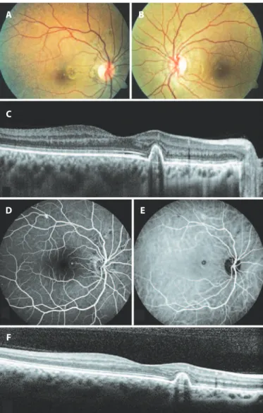 Figure 1. A) Color fundus photography of the right eye demonstrated radial and cir­