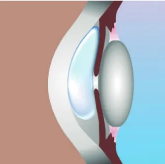 Figure 1. Anterior segment optical coherence tomography (Visante®; Carl Zeiss Medi- Medi-tec, Dublin, CA) demonstrating difuse ixed dilated pupil after DALK with air bubble