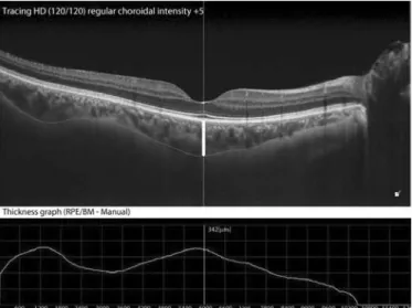 Figure 2. Measurements of the ganglion cell complex thickness in the migraine and  control groups.