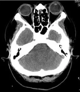 Figure 1. CT scan of the patient showing a transscleral mass on  the left eye.