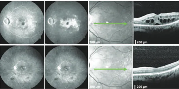 Figure 1. A patient with mild glaucoma and PCME following cataract surgery. Top: FA demonstrates hyperluorescence with a petaloid aspect  in the late frames, and the SD-OCT displays cystic abnormalities, as well as subretinal luid