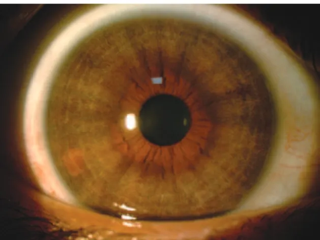 Figure 2. Difuse bilateral iris atrophy in the left eye.