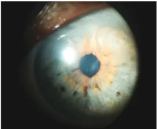 Figure 3. Complete resolution of corneal edema clinically observed at 24 months  postoperatively.