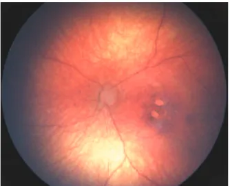 Figure 3. Wide-angle fundus image (Retcam®) of the left eye of infant number  10 with microcephaly showing an optic disc hypoplasia associated with gross  macular pigment mottling and two juxtafoveal chorioretinal atrophic lesions.