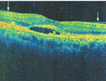 Figure 1. Image obtained with spectral domain optical coherence tomography  (Cirrus HD-OCT), showing the hyaloid adhering to the macular area (arrows).