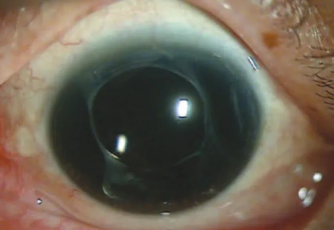 Figure 1. Anterior segment photo showing total aniridia with an intact ciliary  body, intraocular lens, and capsular bag.