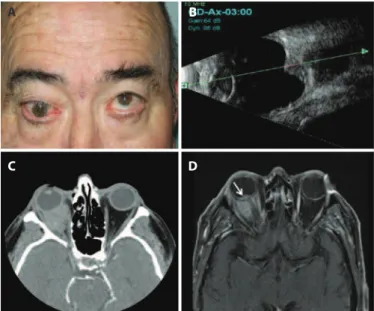 Figure 1. Clinical and imaging indings. (A) Right eye proptosis and limited up-gaze. 
