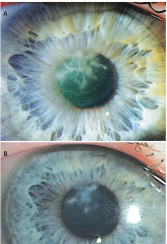 Figure 3. Histology of the amputated corneal lap showing fungal elements in the stroma  (black arrows).