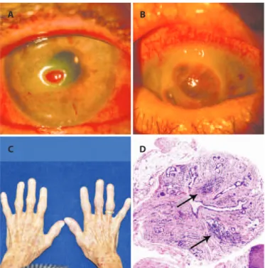 Figure 3. A 71­year­old woman with bilateral corneal ulcers, weight loss, and features  of autoimmune disease afecting her hands