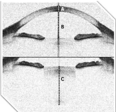 Figure 1. Parameters measured using the Visante ® omni  system. A) Central corneal  thickness