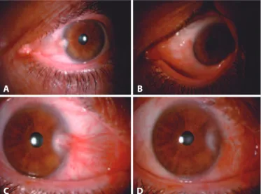 Figure 2. One patient’s preoperative (A) and postoperative (B) appearance. Another  patient’s preoperative (C) and postoperative (D) appearance.