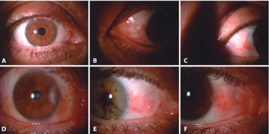 Figure 3. A-F) Examples of postoperative conjunctival redness in Group 1: from none (a) to the worst (f ).