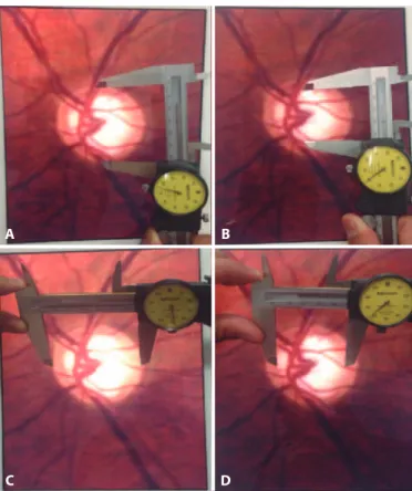 Figure 1. Example of the process for obtaining linear measurements of the vertical and  horizontal disk cup