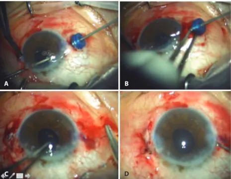 Figure 2. A) The second haptic was captured with a 23-gauge serrated forceps entering from the trocar